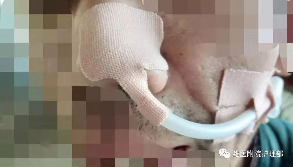 怎么固定引流管八种引流管固定方法，固定得结实又漂亮！_https://www.jmylbn.com_新闻资讯_第28张