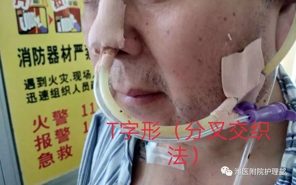 怎么固定引流管八种引流管固定方法，固定得结实又漂亮！_https://www.jmylbn.com_新闻资讯_第24张