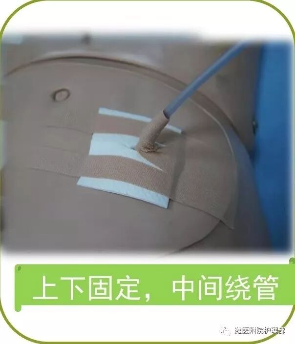 怎么固定引流管八种引流管固定方法，固定得结实又漂亮！_https://www.jmylbn.com_新闻资讯_第15张