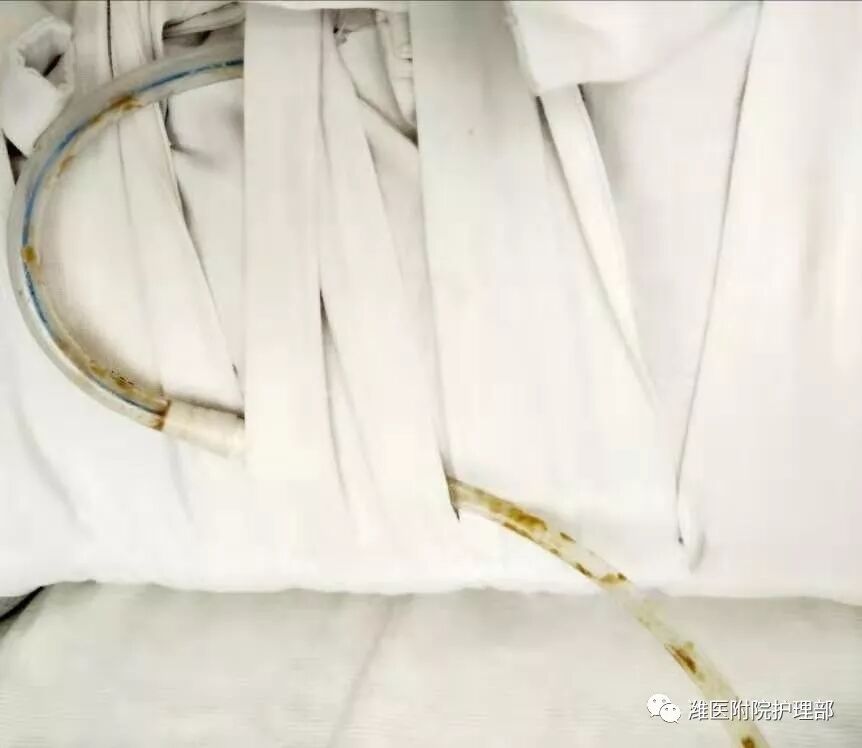 怎么固定引流管八种引流管固定方法，固定得结实又漂亮！_https://www.jmylbn.com_新闻资讯_第19张