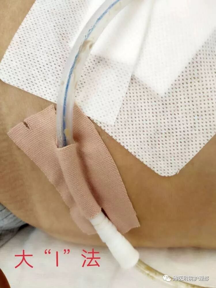 怎么固定引流管八种引流管固定方法，固定得结实又漂亮！_https://www.jmylbn.com_新闻资讯_第7张