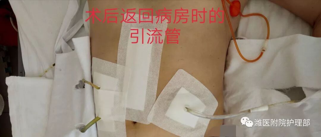 怎么固定引流管八种引流管固定方法，固定得结实又漂亮！_https://www.jmylbn.com_新闻资讯_第3张