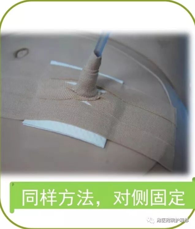 怎么固定引流管八种引流管固定方法，固定得结实又漂亮！_https://www.jmylbn.com_新闻资讯_第16张