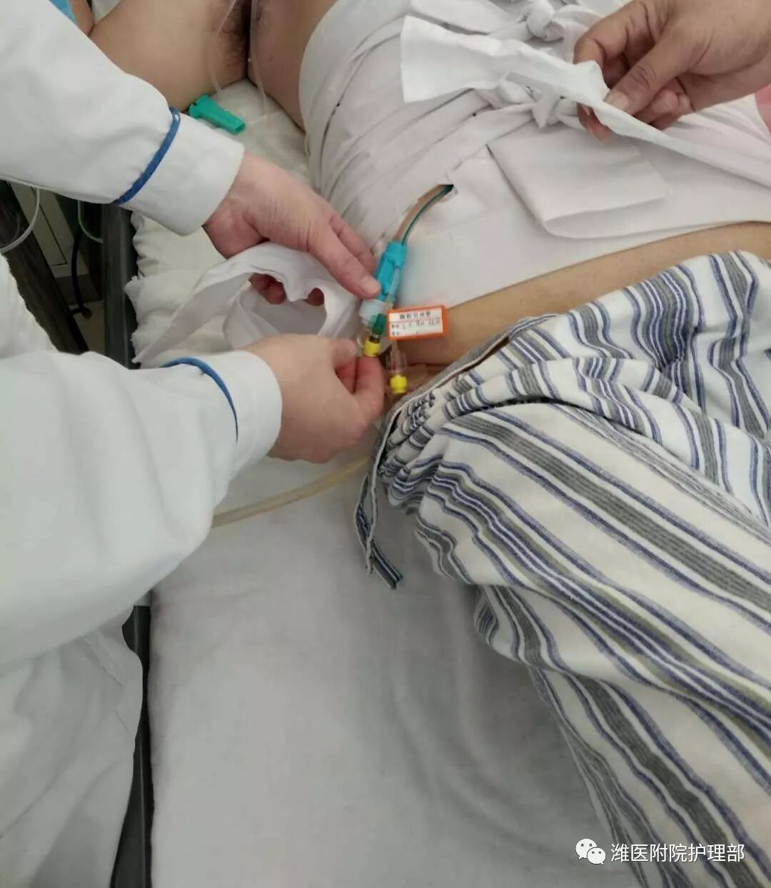 怎么固定引流管八种引流管固定方法，固定得结实又漂亮！_https://www.jmylbn.com_新闻资讯_第20张