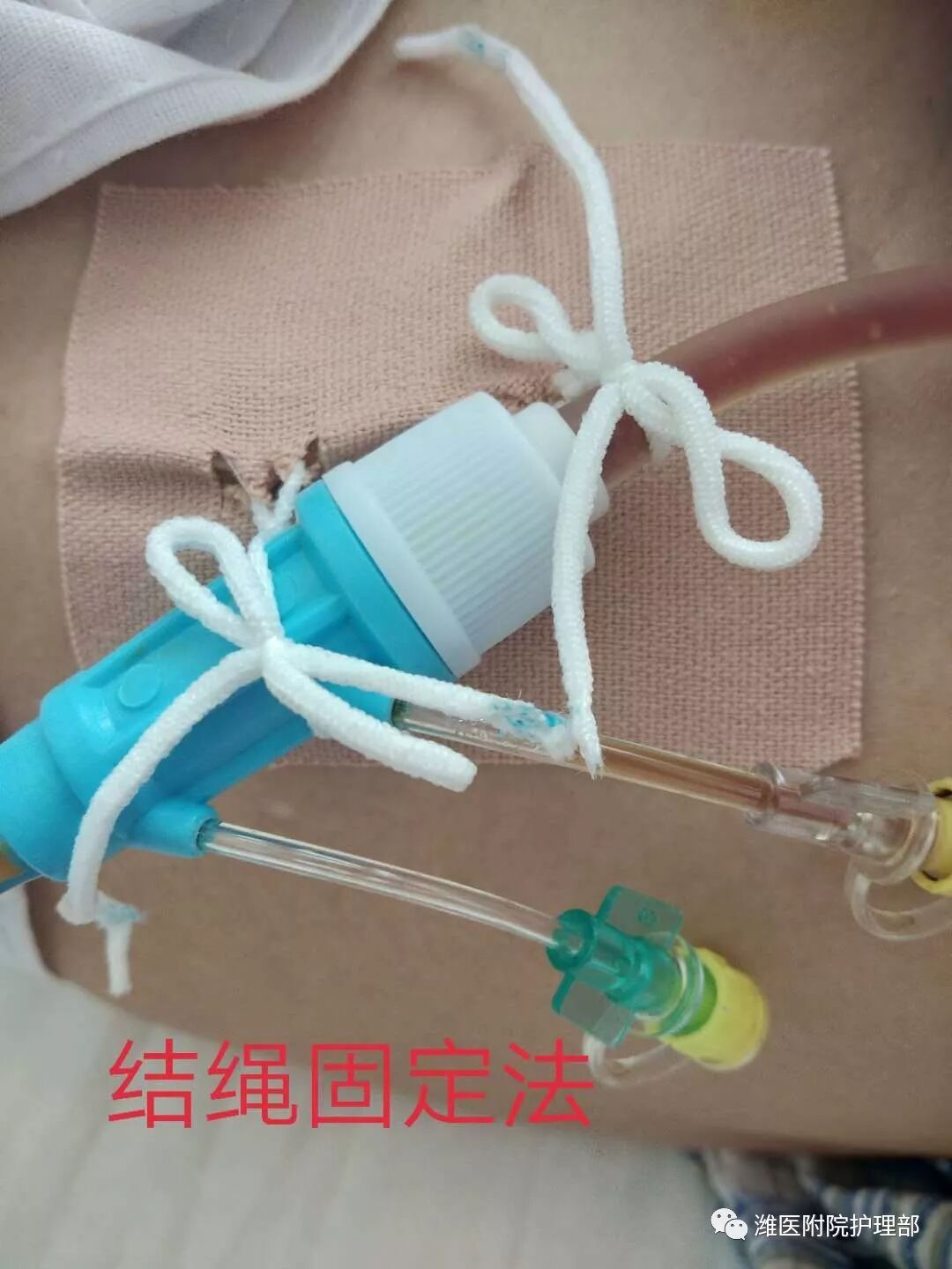 怎么固定引流管八种引流管固定方法，固定得结实又漂亮！_https://www.jmylbn.com_新闻资讯_第11张