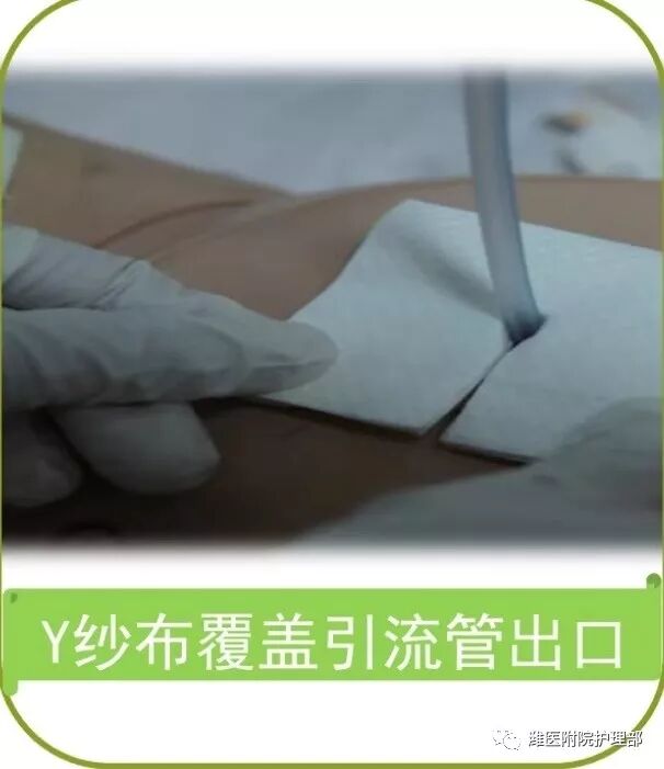 怎么固定引流管八种引流管固定方法，固定得结实又漂亮！_https://www.jmylbn.com_新闻资讯_第14张