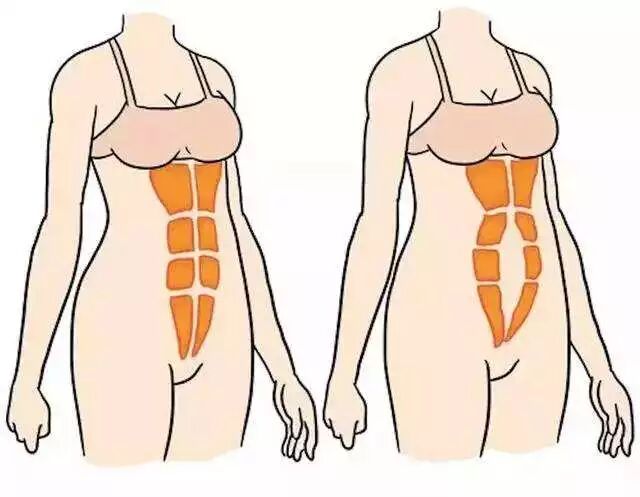 腹直肌分离的原因和禁忌