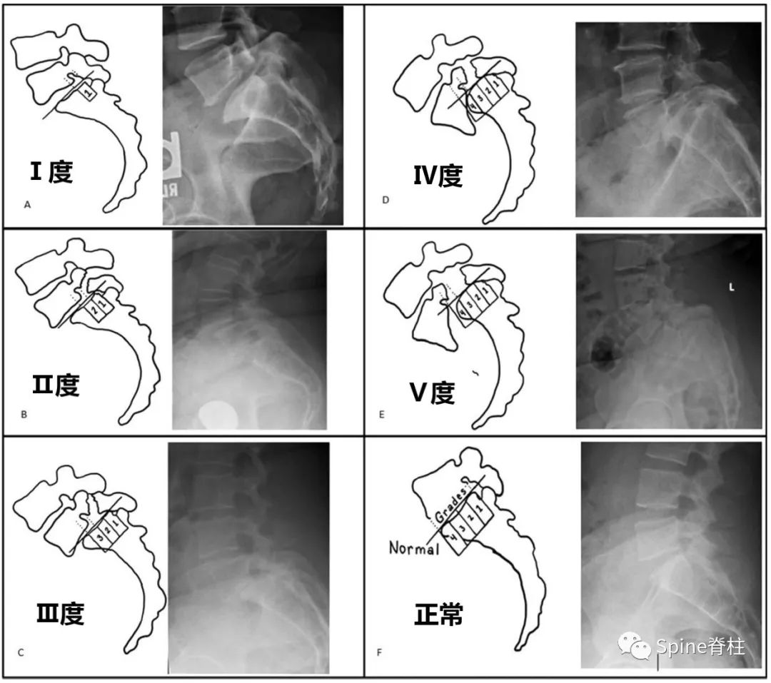 4.8 股骨颈基底截骨术治疗股骨头骨骺滑脱-儿科学-医学