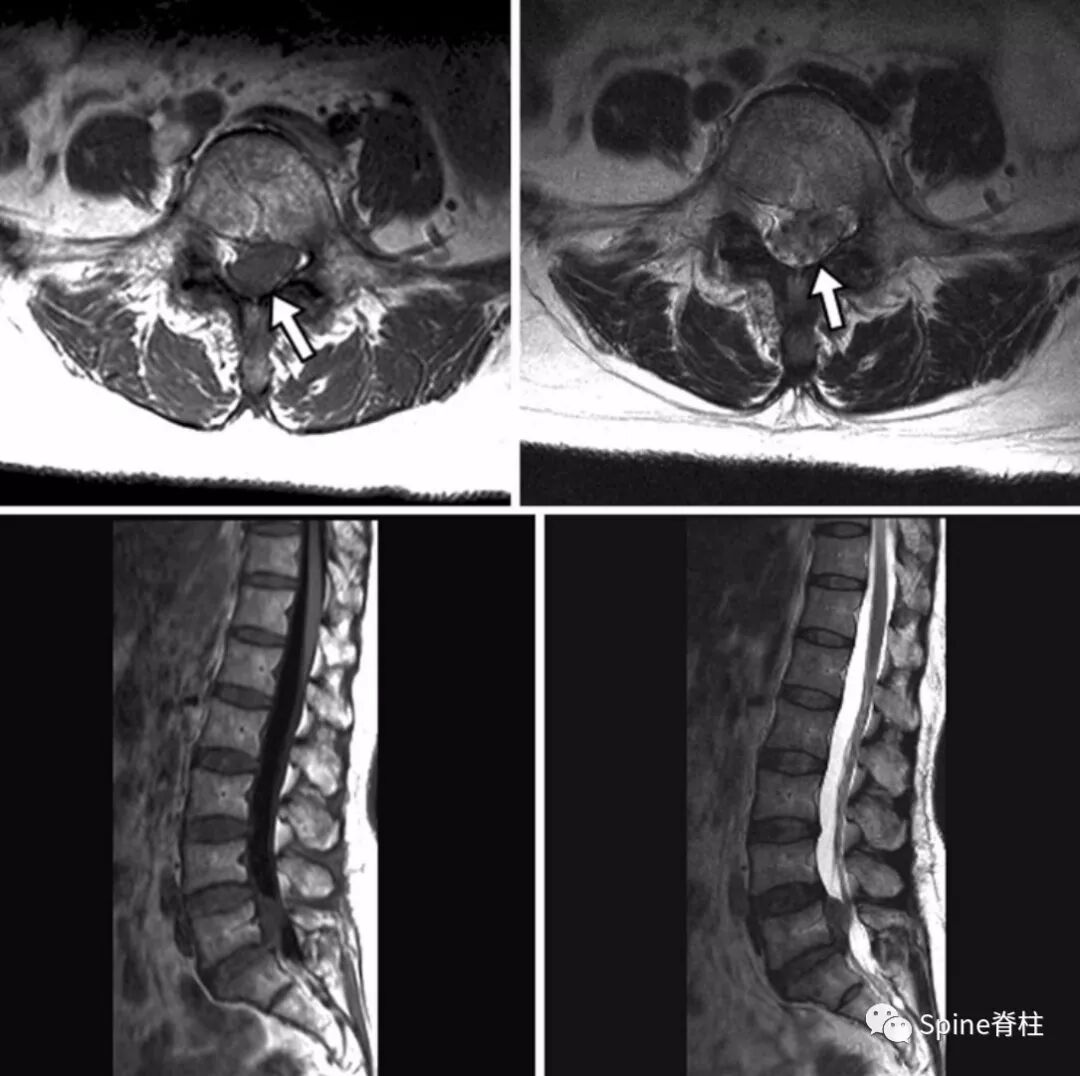详解 硬膜内椎间盘突出症 Spine脊柱 微信公众号文章阅读 Wemp