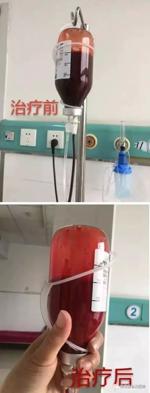 三氧疗法怎么代理德国三氧（O3）大自血疗法：能显著降脂软化血管疏通循环_https://www.jmylbn.com_新闻资讯_第4张