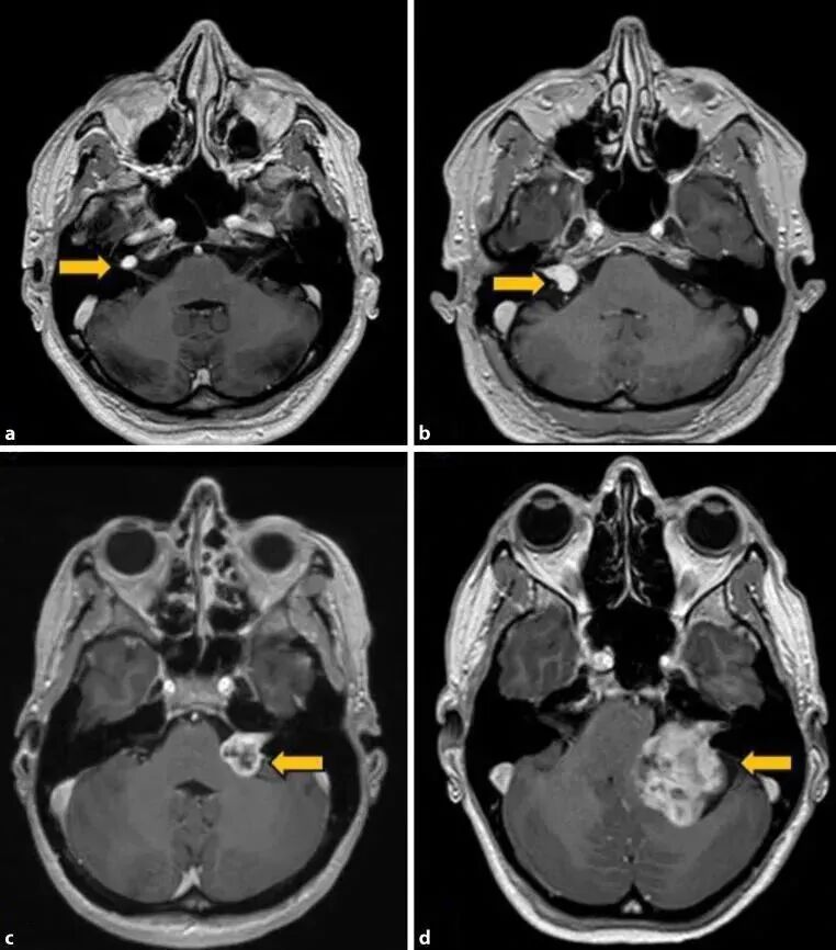 博闻 | 熬夜后耳鸣、听不清？警惕突发性耳聋！(图16)