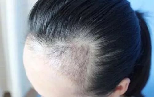 一到秋天头发掉得更严重了？教你一招，脱发好多了，还长出了小绒毛