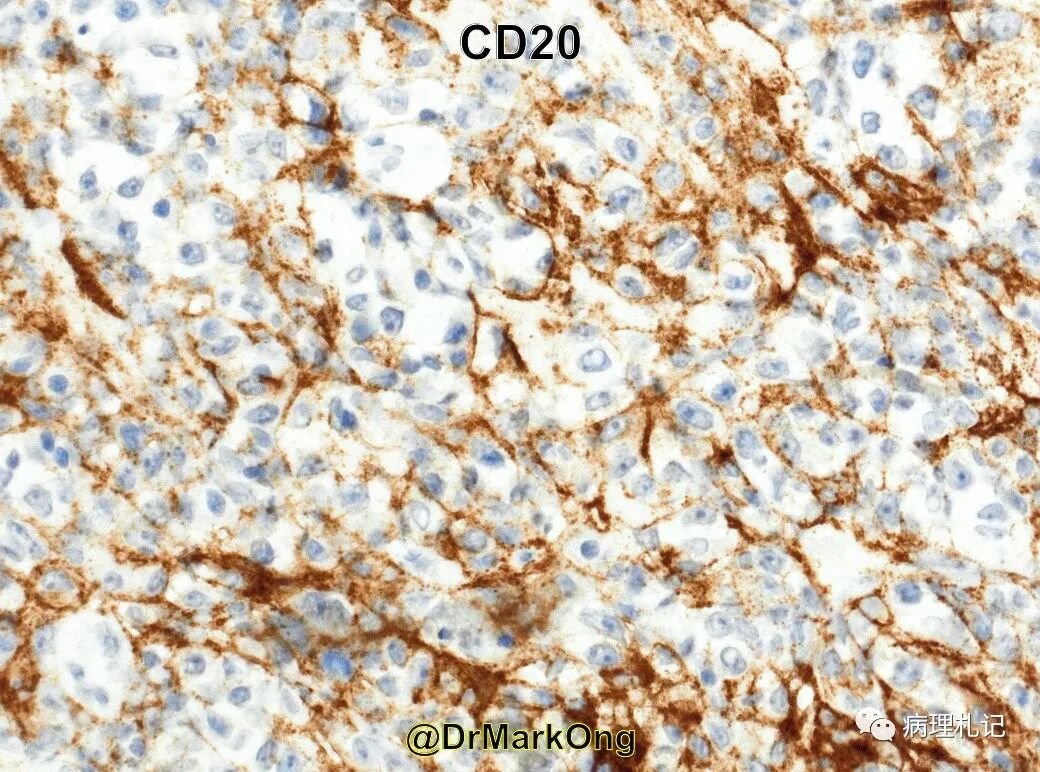纤维蛋白相关的弥漫性大b细胞淋巴瘤的镜下观