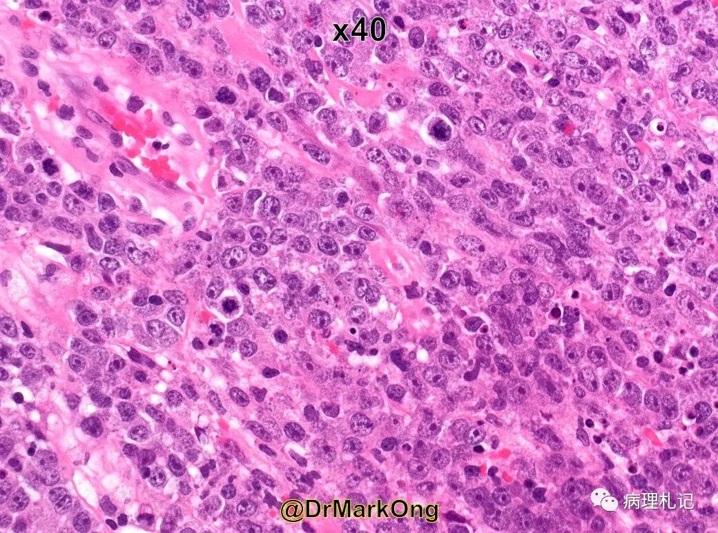 纤维蛋白相关的弥漫性大b细胞淋巴瘤的镜下观