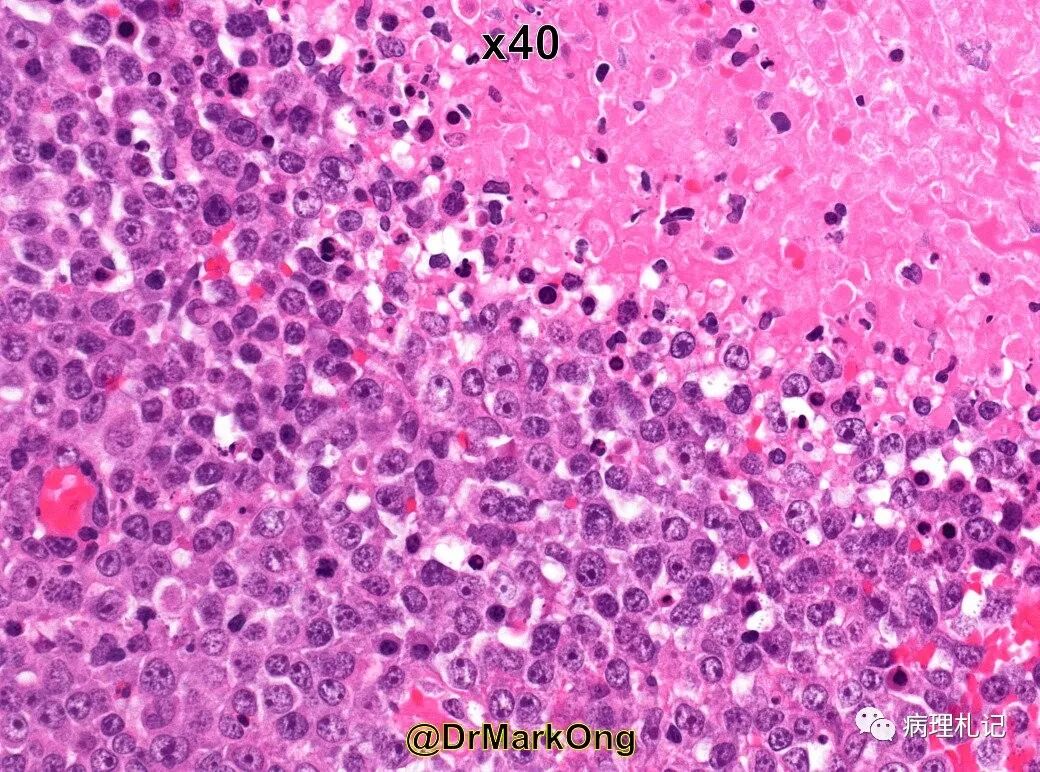 纤维蛋白相关的弥漫性大b细胞淋巴瘤的镜下观