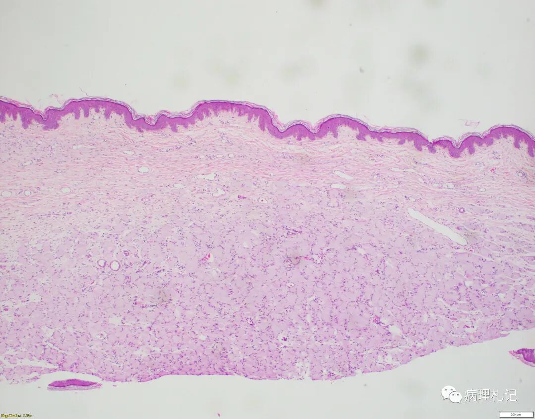弥漫性神经纤维瘤中惊叹wagnermeissner小体