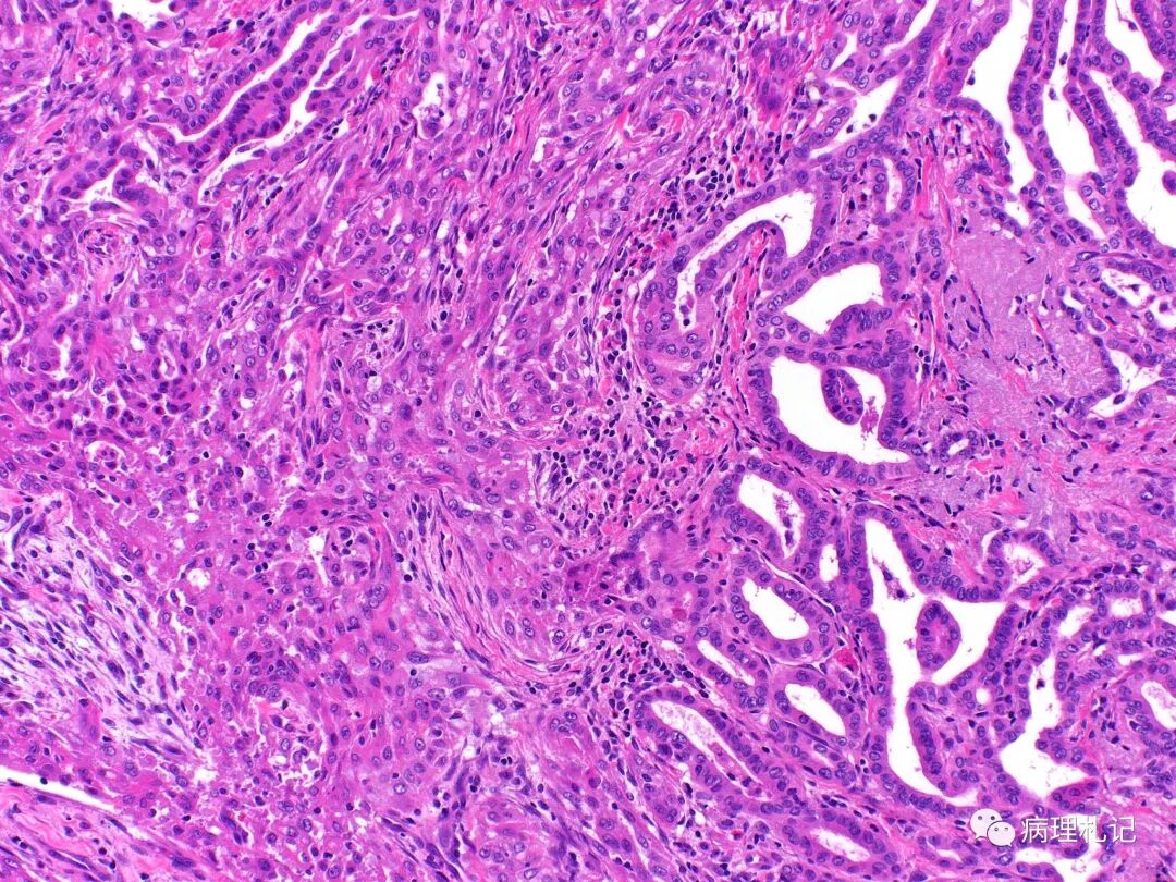 病理视角甲状腺乳头状癌向甲状腺未分化癌的转变
