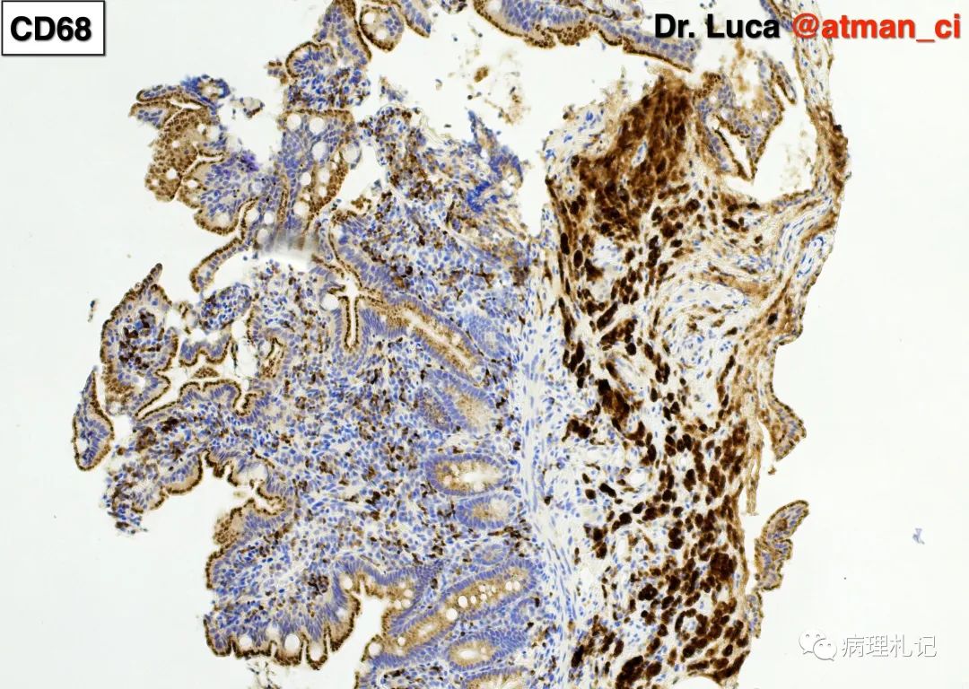 病理視角|「雞爪」粘液樣脂肪肉瘤_醫學界-助力醫生臨床決策和職業