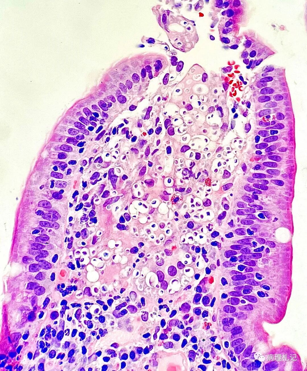 874-膀胱bx- fontana-masson染色强调黑色素沉积.膀胱黑变病.