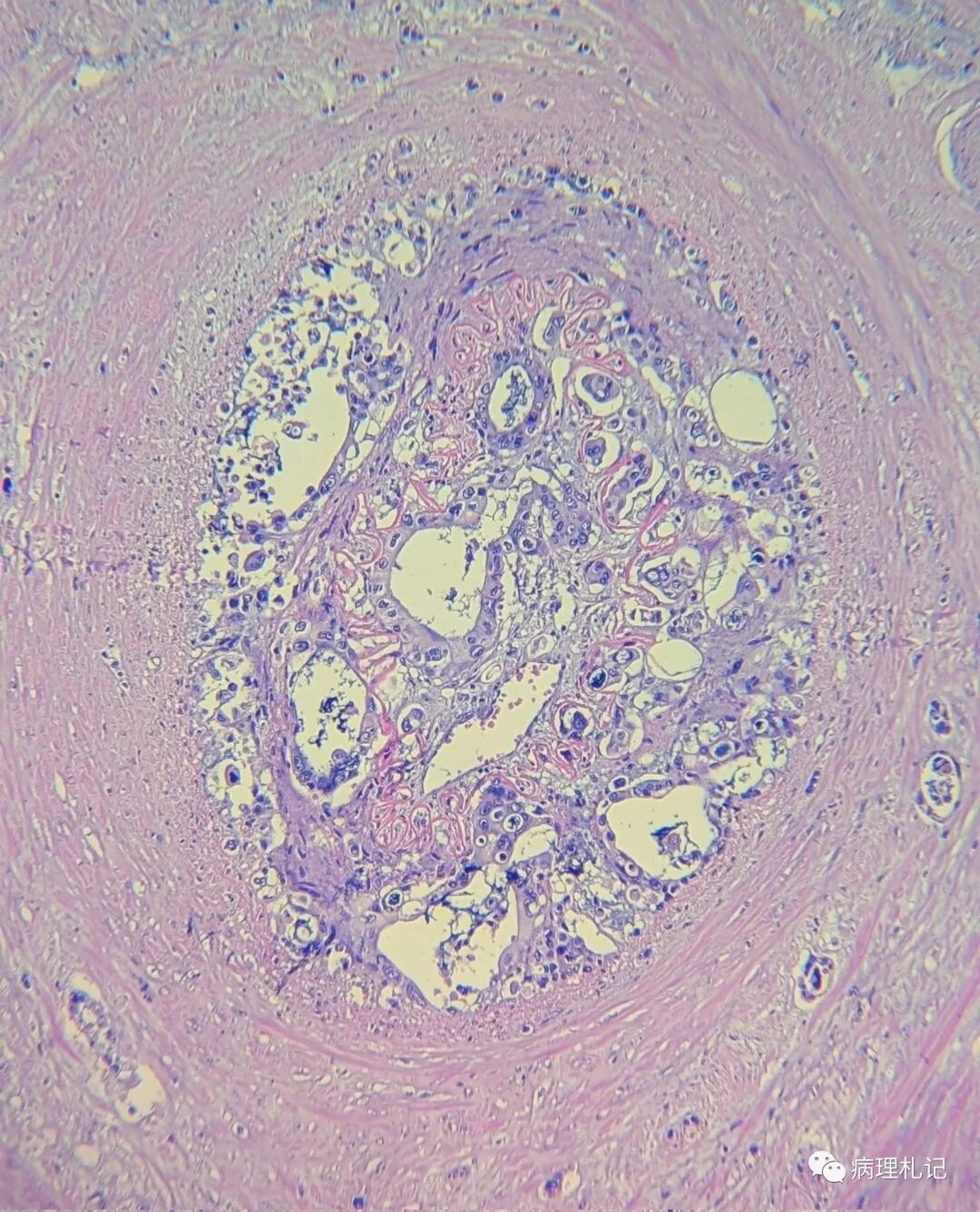 一例粘膜良性上皮样神经鞘瘤的病理报告