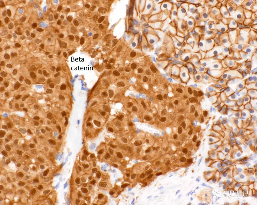 定义:细胞来源和发病机理不明的低度恶性潜能肿瘤.
