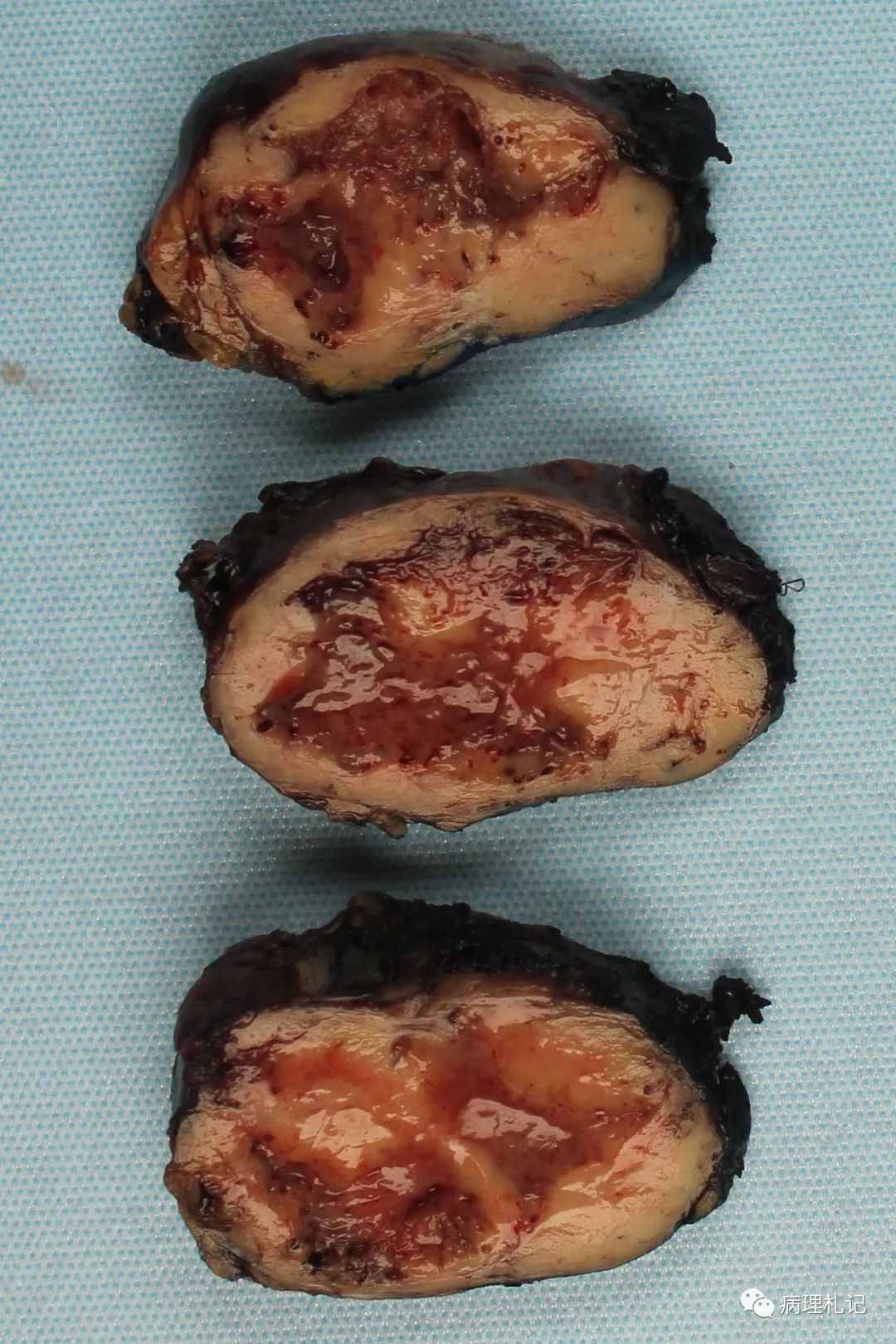 實性假乳頭狀腫瘤solid pseudopapillary neoplasm孤立,圓形,邊界清楚