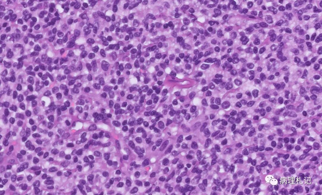 杯状细胞和潘氏细胞缺失,隐窝大量凋亡.