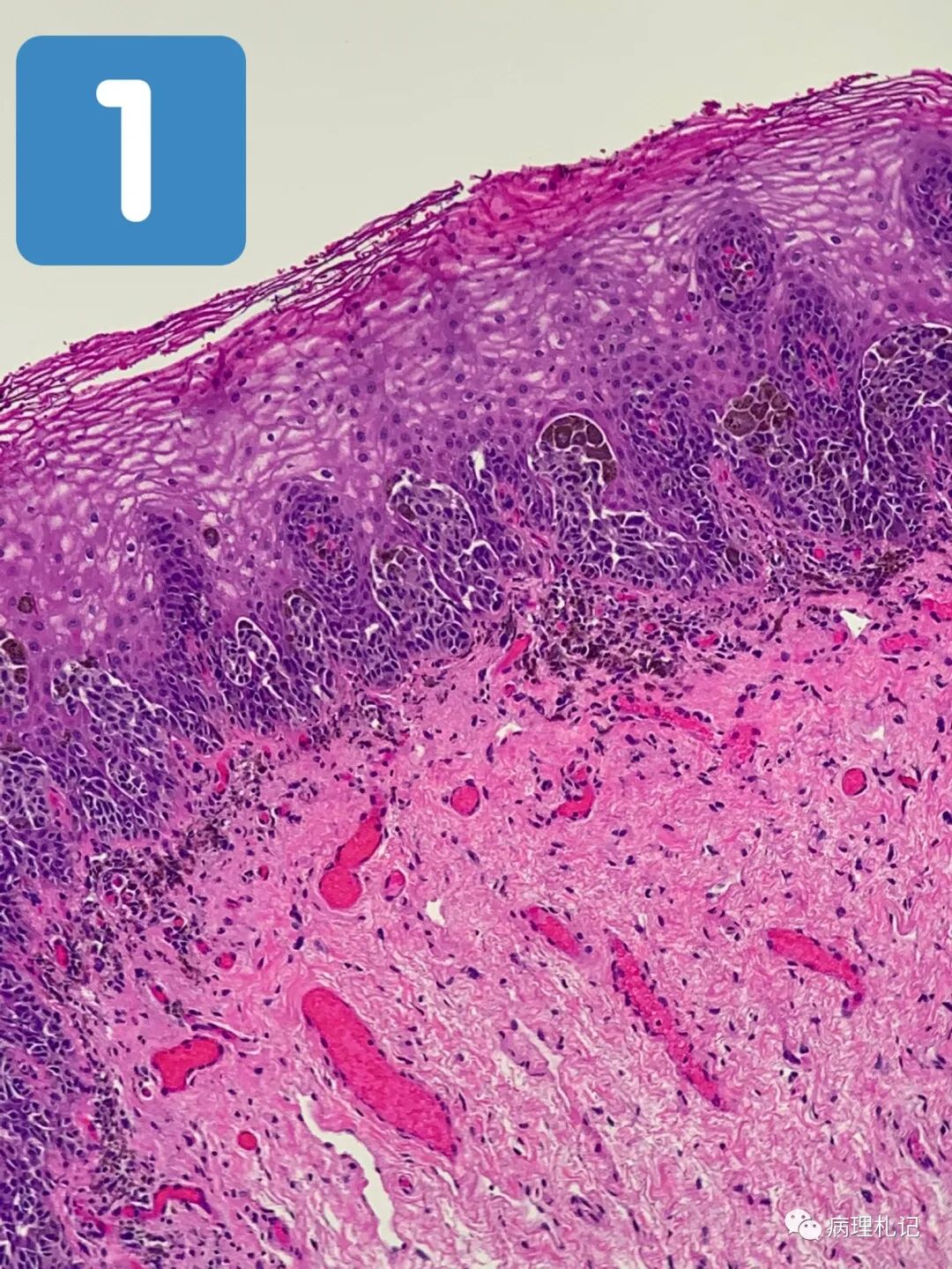 病理视角|外阴原位黑色素瘤,恶性黑色素瘤_医学界-助力医生临床决策和