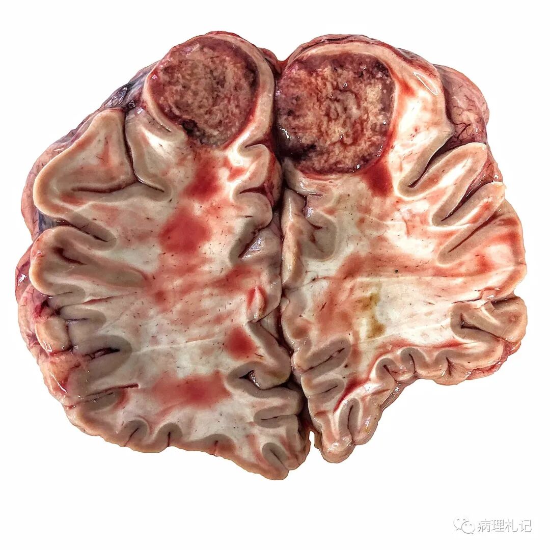 病理视角|孤立性纤维性肿瘤:20岁男性,左侧阴囊肿胀3年_医学界-助力