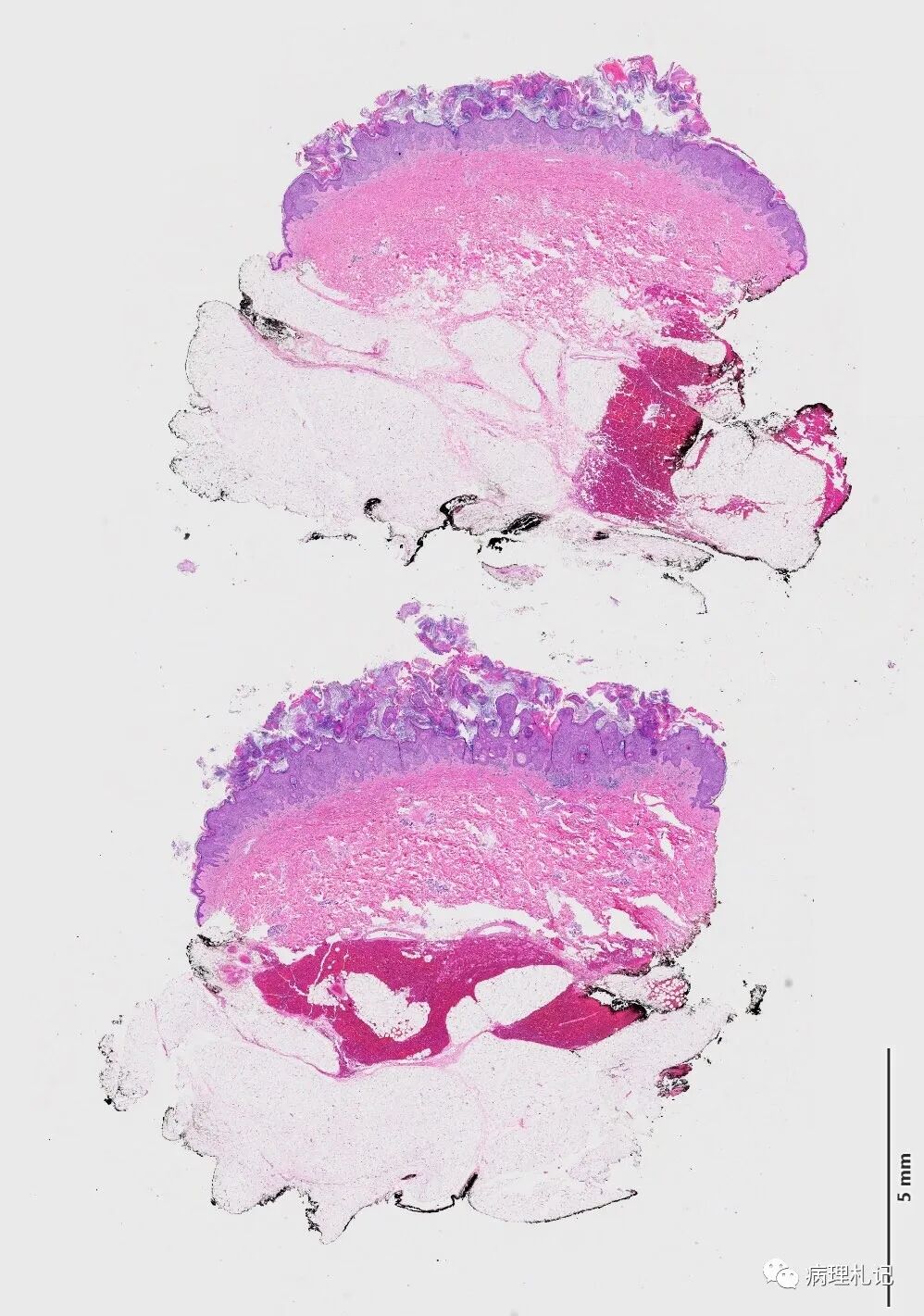病理视角|一种具有透明细胞棘皮瘤样特征的脂溢性角化病_医学界-助力