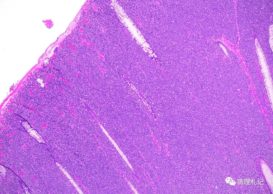 肺浸润性粘液腺癌中杯状细胞的比例与恶性潜能有关_医学界-助力医生