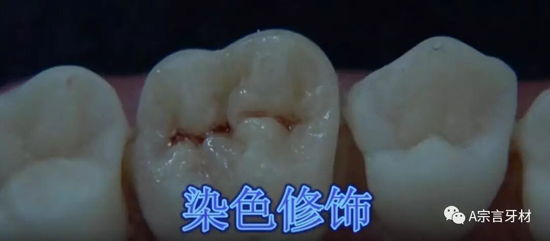 根据邻牙窝沟颜色选择合适的染色剂修饰窝沟.