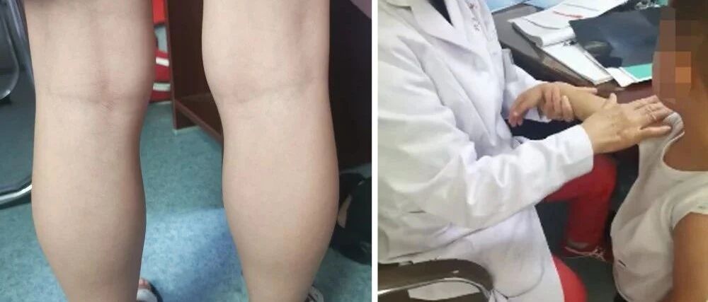 7岁小朋友患上肌营养不良，中医治疗，让他开启新的“人生”