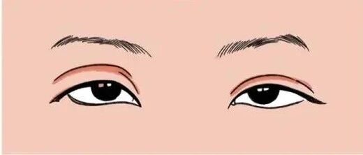 48岁的张女士身患重症肌无力两年，如今终于好转！正确的治疗选择，是康复的关键！