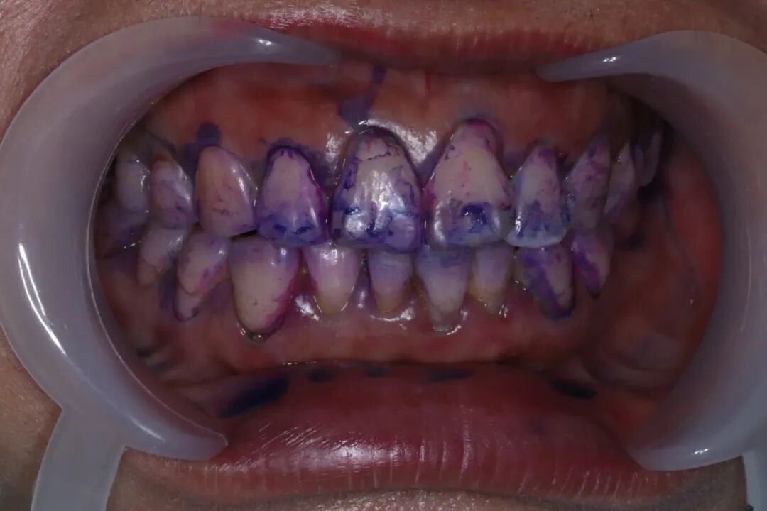 ems洁牙尖怎么分【案例分享】烟渍、牙菌斑的克星——喷砂洁牙！_https://www.jmylbn.com_新闻资讯_第25张