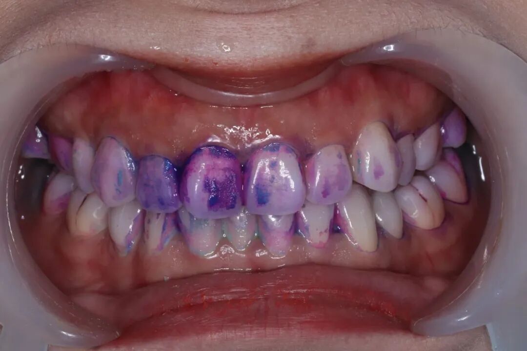 ems洁牙尖怎么分【案例分享】烟渍、牙菌斑的克星——喷砂洁牙！_https://www.jmylbn.com_新闻资讯_第6张