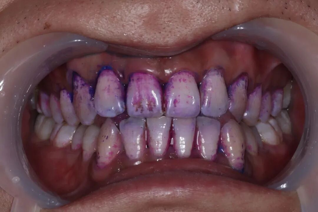 ems洁牙尖怎么分【案例分享】烟渍、牙菌斑的克星——喷砂洁牙！_https://www.jmylbn.com_新闻资讯_第13张