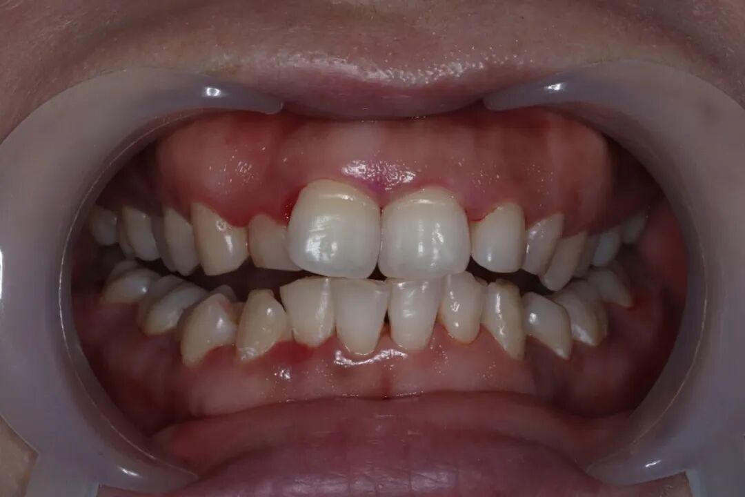 ems洁牙尖怎么分【案例分享】烟渍、牙菌斑的克星——喷砂洁牙！_https://www.jmylbn.com_新闻资讯_第21张