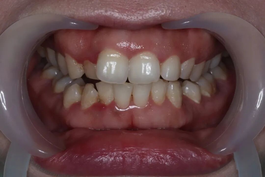 ems洁牙尖怎么分【案例分享】烟渍、牙菌斑的克星——喷砂洁牙！_https://www.jmylbn.com_新闻资讯_第17张