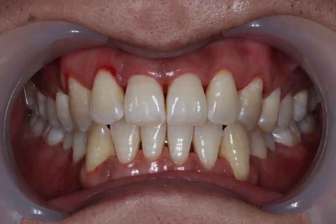 ems洁牙尖怎么分【案例分享】烟渍、牙菌斑的克星——喷砂洁牙！_https://www.jmylbn.com_新闻资讯_第15张