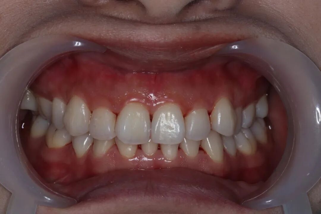 ems洁牙尖怎么分【案例分享】烟渍、牙菌斑的克星——喷砂洁牙！_https://www.jmylbn.com_新闻资讯_第8张