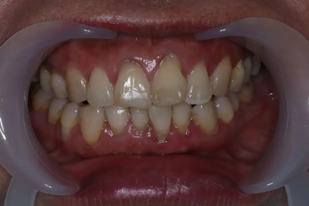 ems洁牙尖怎么分【案例分享】烟渍、牙菌斑的克星——喷砂洁牙！_https://www.jmylbn.com_新闻资讯_第23张