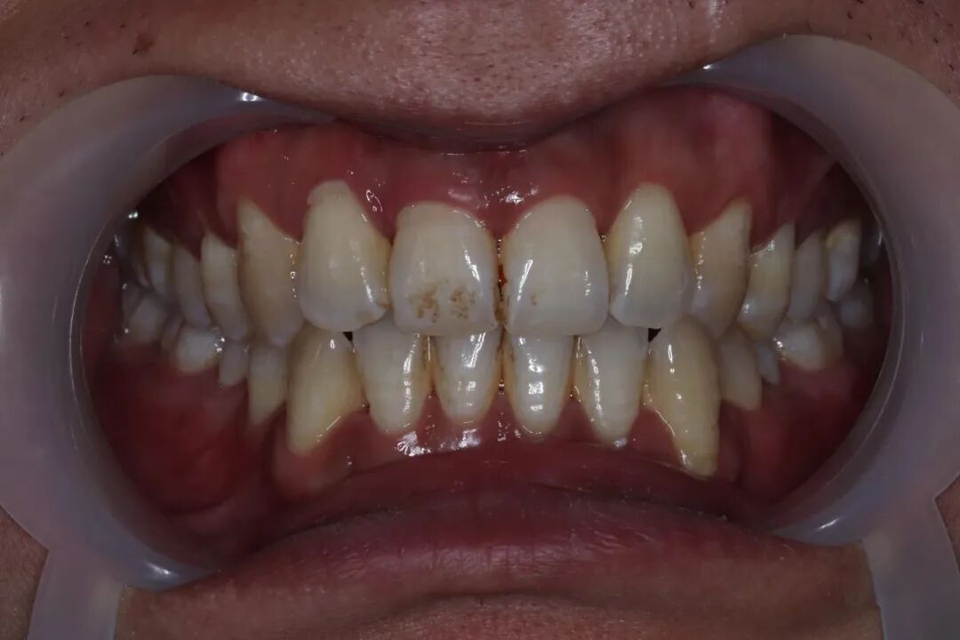 ems洁牙尖怎么分【案例分享】烟渍、牙菌斑的克星——喷砂洁牙！_https://www.jmylbn.com_新闻资讯_第11张