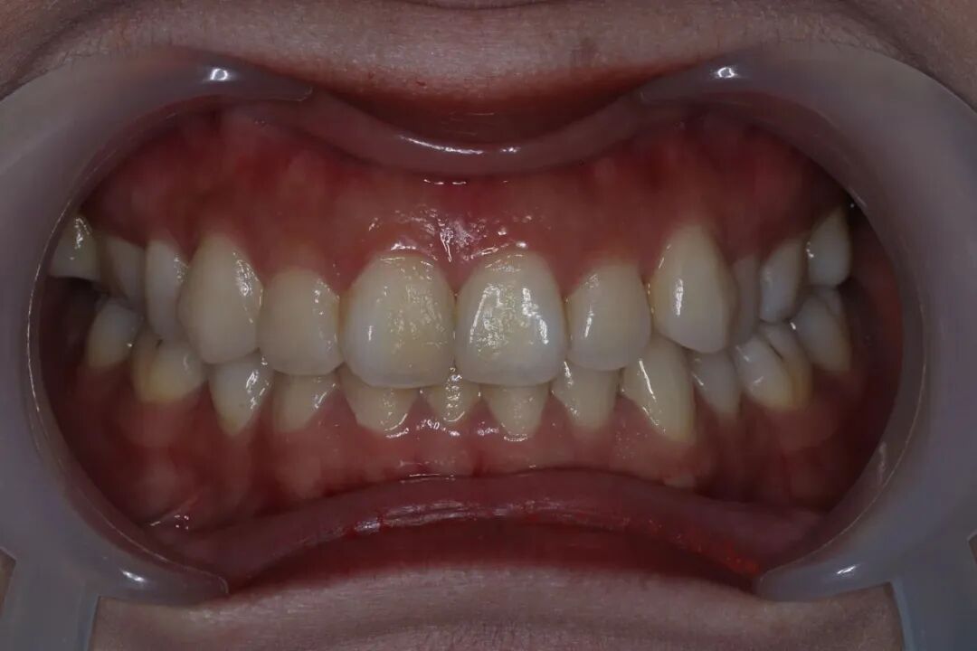 ems洁牙尖怎么分【案例分享】烟渍、牙菌斑的克星——喷砂洁牙！_https://www.jmylbn.com_新闻资讯_第4张