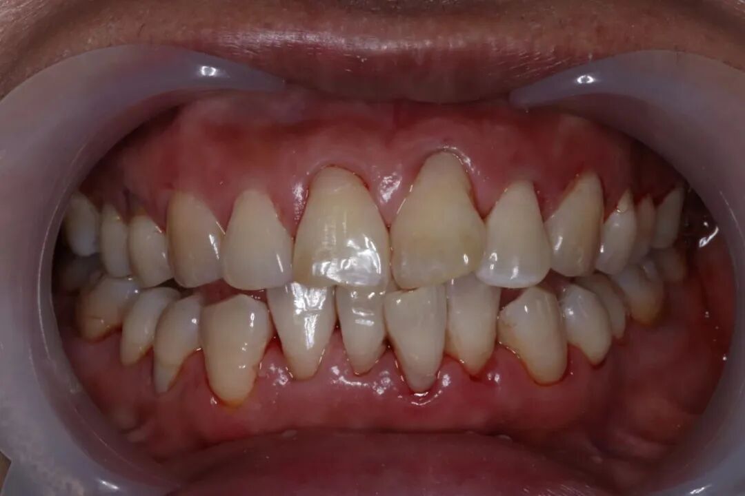 ems洁牙尖怎么分【案例分享】烟渍、牙菌斑的克星——喷砂洁牙！_https://www.jmylbn.com_新闻资讯_第27张