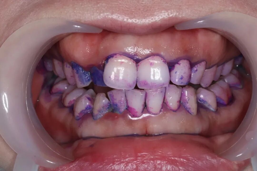 ems洁牙尖怎么分【案例分享】烟渍、牙菌斑的克星——喷砂洁牙！_https://www.jmylbn.com_新闻资讯_第19张