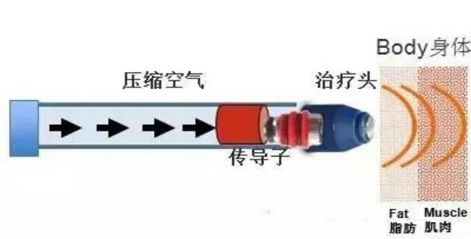 隔物灸有什么作用【新技术】没有子弹的枪——冲击波，让你远离疼痛_https://www.jmylbn.com_新闻资讯_第14张