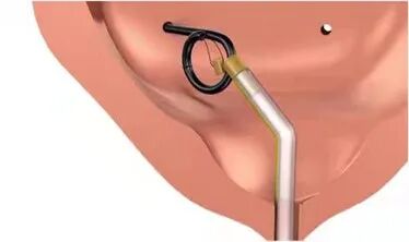 猪输尿管怎么吃泌尿外科医生常说的“猪尾巴管”是什么？_https://www.jmylbn.com_新闻资讯_第4张