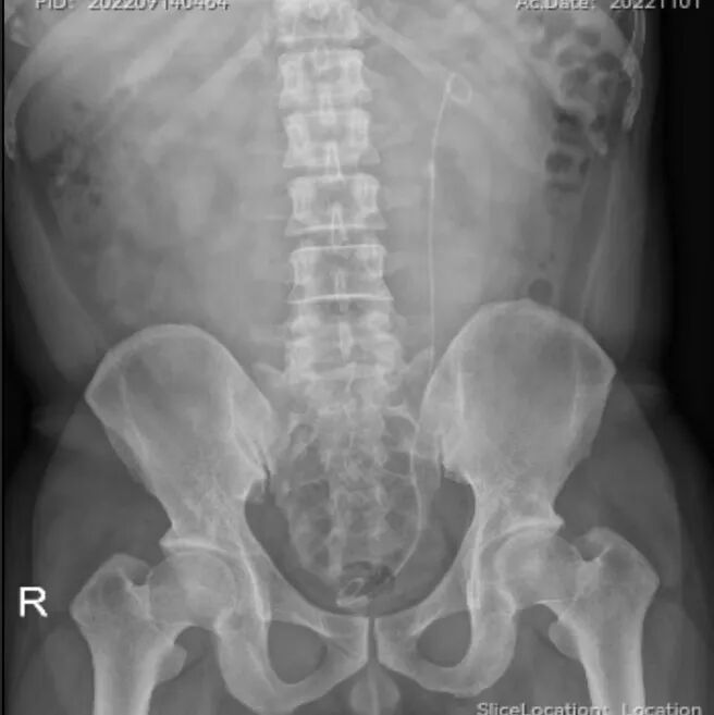 猪输尿管怎么吃泌尿外科医生常说的“猪尾巴管”是什么？_https://www.jmylbn.com_新闻资讯_第3张