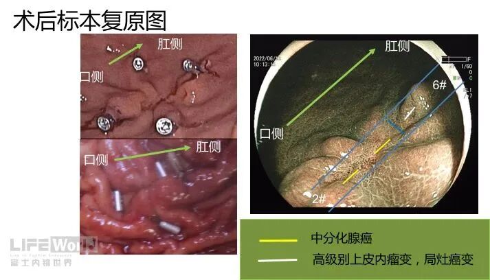 富士胃镜英文怎么写病例分享 ｜ 周环：一例不易判断的胃体病变的诊治分享（富士内镜早癌读片会）_https://www.jmylbn.com_新闻资讯_第39张